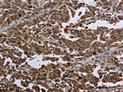 The image on the left is immunohistochemistry of paraffin-embedded Human liver cancer tissue using the antibody Antibody) at dilution 1/50, on the right is treated with fusion protein. (Original magnification: ×200)Rabbit anti-Human HSPA9 Polyclonal Antibody