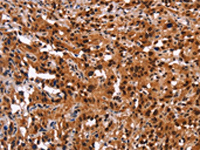 The image on the left is immunohistochemistry of paraffin-embedded Human thyroid cancer tissue using GPR124 Antibody(GPR124 Antibody) at dilution 1/40, on the right is treated with synthetic peptide. (Original magnification: ×200)Rabbit anti-Human GPR124 Polyclonal Antibody