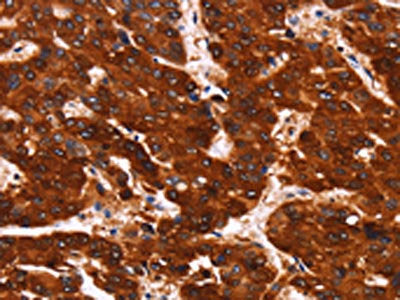 The image on the left is immunohistochemistry of paraffin-embedded Human liver cancer tissue using the antibody Antibody) at dilution 1/40, on the right is treated with synthetic peptide. (Original magnification: ×200)Rabbit anti-Human GPR124 Polyclonal Antibody