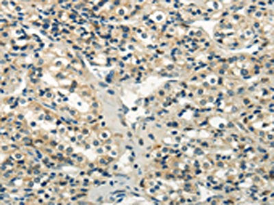 The image on the left is immunohistochemistry of paraffin-embedded Human prostate cancer tissue using WNK2 Antibody(WNK2 Antibody) at dilution 1/35, on the right is treated with synthetic peptide. (Original magnification: ×200)Rabbit anti-Human WNK2 Polyclonal Antibody