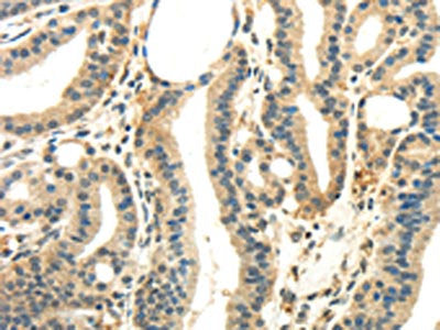 The image on the left is immunohistochemistry of paraffin-embedded Human thyroid cancer tissue using the antibody Antibody) at dilution 1/35, on the right is treated with synthetic peptide. (Original magnification: ×200)Rabbit anti-Human WNK2 Polyclonal Antibody