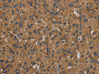 The image on the left is immunohistochemistry of paraffin-embedded Human liver cancer tissue using the antibody Antibody) at dilution 1/50, on the right is treated with fusion protein. (Original magnification: ×200)Rabbit anti-Human GBP5 Polyclonal Antibody