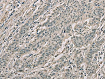 The image on the left is immunohistochemistry of paraffin-embedded Human gastric cancer tissue using RNASE3 Antibody(RNASE3 Antibody) at dilution 1/20, on the right is treated with fusion protein. (Original magnification: ×200)Rabbit anti-Human RNASE3 Polyclonal Antibody