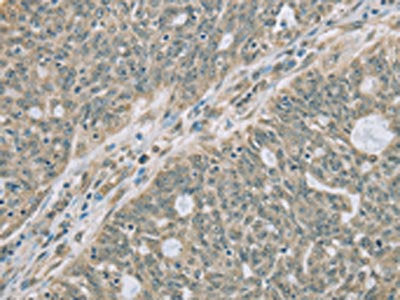 The image on the left is immunohistochemistry of paraffin-embedded Human ovarian cancer tissue using the antibody Antibody) at dilution 1/20, on the right is treated with fusion protein. (Original magnification: ×200)Rabbit anti-Human RNASE3 Polyclonal Antibody