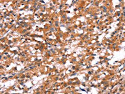 The image on the left is immunohistochemistry of paraffin-embedded Human thyroid cancer tissue using SLC6A1 Antibody(SLC6A1 Antibody) at dilution 1/20, on the right is treated with synthetic peptide. (Original magnification: ×200)Rabbit anti-Human SLC6A1 Polyclonal Antibody