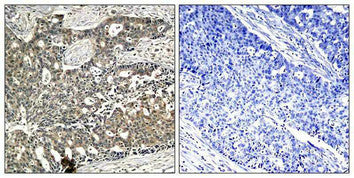 Immunohistochemical analysis of paraffin-embedded human breast carcinoma tissue using p56Dok-2(Phospho-Tyr299) Antibody(left) or the same antibody preincubated with blocking peptide(right).Rabbit anti-Human DOK2 Polyclonal Antibody