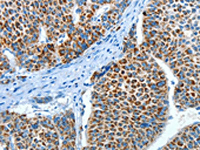 The image on the left is immunohistochemistry of paraffin-embedded Human liver cancer tissue using ALDH4A1 Antibody(ALDH4A1 Antibody) at dilution 1/45, on the right is treated with fusion protein. (Original magnification: ×200)Rabbit anti-Human ALDH4A1 Polyclonal Antibody