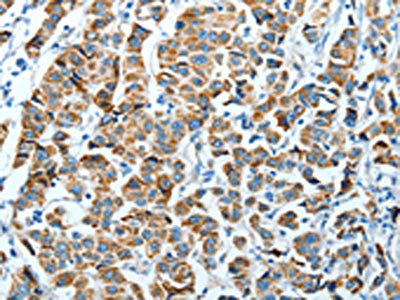 The image on the left is immunohistochemistry of paraffin-embedded Human breast cancer tissue using the antibody Antibody) at dilution 1/45, on the right is treated with fusion protein. (Original magnification: ×200)Rabbit anti-Human ALDH4A1 Polyclonal Antibody