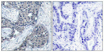 Immunohistochemical analysis of paraffin-embedded human breast carcinoma tissue using eIF4E(Phospho-Ser209) Antibody(left) or the same antibody preincubated with blocking peptide(right).Rabbit anti-Human EIF4E Polyclonal Antibody