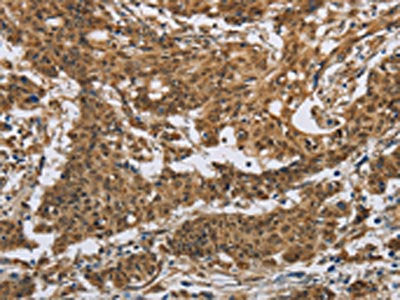 The image on the left is immunohistochemistry of paraffin-embedded Human gastric cancer tissue using IL5RA Antibody(IL5RA Antibody) at dilution 1/40, on the right is treated with synthetic peptide. (Original magnification: ×200)Rabbit anti-Human IL5RA Polyclonal Antibody