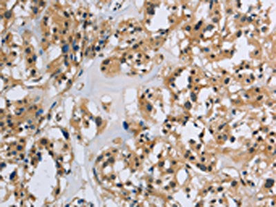 The image on the left is immunohistochemistry of paraffin-embedded Human thyroid cancer tissue using the antibody Antibody) at dilution 1/40, on the right is treated with synthetic peptide. (Original magnification: ×200)Rabbit anti-Human IL5RA Polyclonal Antibody