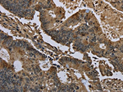 The image on the left is immunohistochemistry of paraffin-embedded Human colon cancer tissue using GSTO1 Antibody(GSTO1 Antibody) at dilution 1/60, on the right is treated with fusion protein. (Original magnification: ×200)