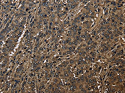 The image on the left is immunohistochemistry of paraffin-embedded Human liver cancer tissue using the antibody Antibody) at dilution 1/60, on the right is treated with fusion protein. (Original magnification: ×200)