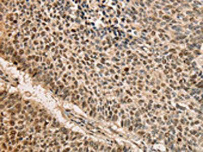 The image on the left is immunohistochemistry of paraffin-embedded Human lung cancer tissue using CDCA8 Antibody(CDCA8 Antibody) at dilution 1/40, on the right is treated with fusion protein. (Original magnification: ×200)Rabbit anti-Human CDCA8 Polyclonal Antibody