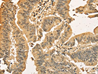 The image on the left is immunohistochemistry of paraffin-embedded Human colon cancer tissue using the antibody Antibody) at dilution 1/40, on the right is treated with fusion protein. (Original magnification: ×200)Rabbit anti-Human CDCA8 Polyclonal Antibody