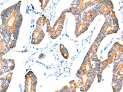 The image on the left is immunohistochemistry of paraffin-embedded Human colon cancer tissue using VANGL1 Antibody(VANGL1 Antibody) at dilution 1/20, on the right is treated with fusion protein. (Original magnification: ×200)Rabbit anti-Human VANGL1 Polyclonal Antibody