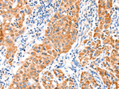 The image on the left is immunohistochemistry of paraffin-embedded Human lung cancer tissue using the antibody Antibody) at dilution 1/20, on the right is treated with fusion protein. (Original magnification: ×200)Rabbit anti-Human VANGL1 Polyclonal Antibody
