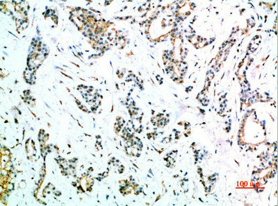 Immunohistochemical analysis of paraffin-embedded human-stomach-cancer, antibody was diluted at 1:200Rabbit anti-Human FCGR1A Polyclonal Antibody