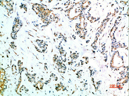 Immunohistochemical analysis of paraffin-embedded human-stomach-cancer, antibody was diluted at 1:200Rabbit anti-Human FCGR1A Polyclonal Antibody