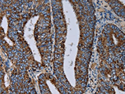 The image on the left is immunohistochemistry of paraffin-embedded Human colon cancer tissue using the antibody Antibody) at dilution 1/20, on the right is treated with fusion protein. (Original magnification: ×200)Rabbit anti-Human NDUFS4 Polyclonal Antibody