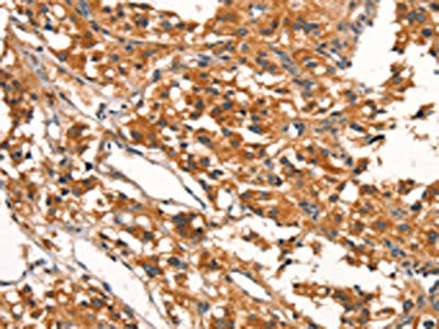 The image on the left is immunohistochemistry of paraffin-embedded Human thyroid cancer tissue using the antibody Antibody) at dilution 1/15, on the right is treated with synthetic peptide. (Original magnification: ×200)Rabbit anti-Human DDAH2 Polyclonal Antibody