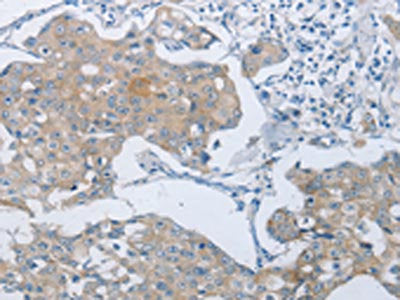 The image on the left is immunohistochemistry of paraffin-embedded Human breast cancer tissue using ABCB9 Antibody(ABCB9 Antibody) at dilution 1/15, on the right is treated with synthetic peptide. (Original magnification: ×200)