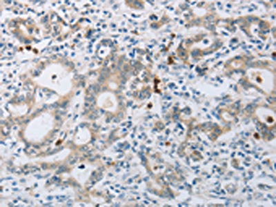 The image on the left is immunohistochemistry of paraffin-embedded Human gastic cancer tissue using the antibody Antibody) at dilution 1/15, on the right is treated with synthetic peptide. (Original magnification: ×200)