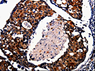 The image is immunohistochemistry of paraffin-embedded Human breast cancer tissue using AK1 Antibody(AK1 Antibody) at dilution 1/25. (Original magnification: ×200)Rabbit anti-Human AK1 Polyclonal Antibody