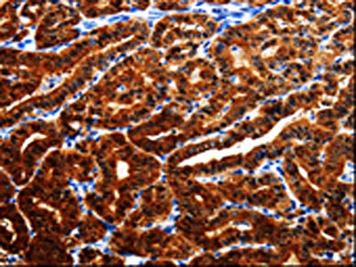 The image is immunohistochemistry of paraffin-embedded Human thyroid cancer tissue using the antibody Antibody) at dilution 1/25. (Original magnification: ×200)Rabbit anti-Human AK1 Polyclonal Antibody