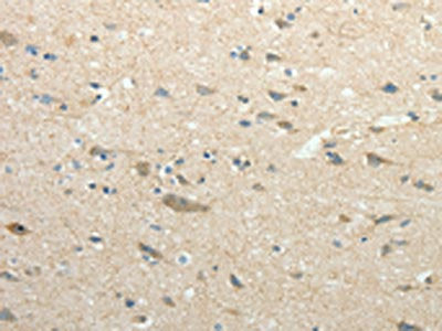 The image on the left is immunohistochemistry of paraffin-embedded Human brain tissue using SIRT3 Antibody(SIRT3 Antibody) at dilution 1/30, on the right is treated with fusion protein. (Original magnification: ×200)Rabbit anti-Human SIRT3 Polyclonal Antibody