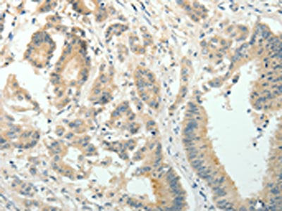 The image on the left is immunohistochemistry of paraffin-embedded Human colon cancer tissue using the antibody Antibody) at dilution 1/30, on the right is treated with fusion protein. (Original magnification: ×200)Rabbit anti-Human SIRT3 Polyclonal Antibody