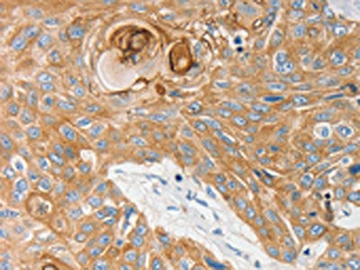 The image on the left is immunohistochemistry of paraffin-embedded Human esophagus cancer tissue using EDNRB Antibody(EDNRB Antibody) at dilution 1/30, on the right is treated with synthetic peptide. (Original magnification: ×200)Rabbit anti-Human EDNRB Polyclonal Antibody