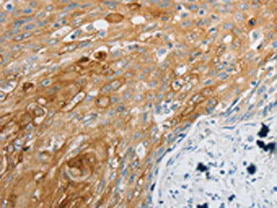 The image on the left is immunohistochemistry of paraffin-embedded Human cervical cancer tissue using the antibody Antibody) at dilution 1/30, on the right is treated with synthetic peptide. (Original magnification: ×200)Rabbit anti-Human EDNRB Polyclonal Antibody