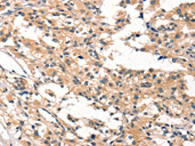 The image on the left is immunohistochemistry of paraffin-embedded Human thyroid cancer tissue using CYP46A1 Antibody(CYP46A1 Antibody) at dilution 1/15, on the right is treated with synthetic peptide. (Original magnification: ×200)