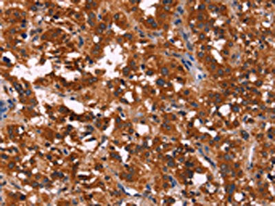 The image on the left is immunohistochemistry of paraffin-embedded Human thyroid cancer tissue using the antibody Antibody) at dilution 1/60, on the right is treated with fusion protein. (Original magnification: ×200)Rabbit anti-Human RPSA Polyclonal Antibody