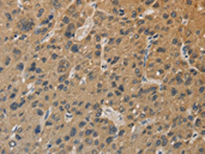 The image on the left is immunohistochemistry of paraffin-embedded Human liver cancer tissue using DDX19B Antibody(DDX19B Antibody) at dilution 1/20, on the right is treated with fusion protein. (Original magnification: ×200)Rabbit anti-Human DDX19B Polyclonal Antibody