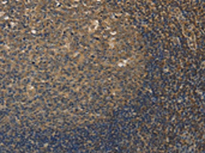 The image on the left is immunohistochemistry of paraffin-embedded Human tonsil tissue using the antibody Antibody) at dilution 1/20, on the right is treated with fusion protein. (Original magnification: ×200)Rabbit anti-Human DDX19B Polyclonal Antibody