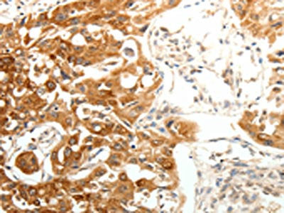 The image on the left is immunohistochemistry of paraffin-embedded Human lung cancer tissue using SOCS3 Antibody(SOCS3 Antibody) at dilution 1/20, on the right is treated with fusion protein. (Original magnification: X200)Rabbit anti-Human SOCS3 Polyclonal Antibody