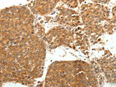 The image on the left is immunohistochemistry of paraffin-embedded Human liver cancer tissue using the antibody Antibody) at dilution 1/20, on the right is treated with fusion protein. (Original magnification: X200)Rabbit anti-Human SOCS3 Polyclonal Antibody