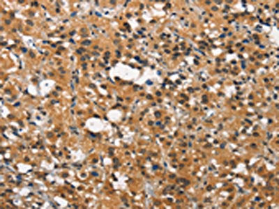 The image on the left is immunohistochemistry of paraffin-embedded Human thyroid cancer tissue using ITGA2 Antibody(ITGA2 Antibody) at dilution 1/15, on the right is treated with synthetic peptide. (Original magnification: ×200)