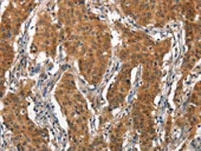 The image on the left is immunohistochemistry of paraffin-embedded Human gastic cancer tissue using the antibody Antibody) at dilution 1/15, on the right is treated with synthetic peptide. (Original magnification: ×200)