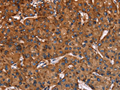 The image on the left is immunohistochemistry of paraffin-embedded Human liver cancer tissue using LAMP2 Antibody(LAMP2 Antibody) at dilution 1/40, on the right is treated with fusion protein. (Original magnification: ×200)