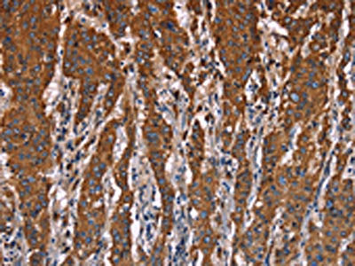 The image on the left is immunohistochemistry of paraffin-embedded Human gastic cancer tissue using the antibody Antibody) at dilution 1/40, on the right is treated with fusion protein. (Original magnification: ×200)