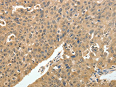The image on the left is immunohistochemistry of paraffin-embedded Human ovarian cancer tissue using PSMD3 Antibody(PSMD3 Antibody) at dilution 1/30, on the right is treated with fusion protein. (Original magnification: ×200)