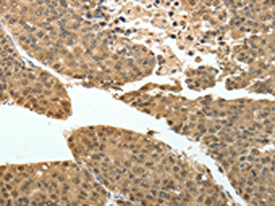 The image on the left is immunohistochemistry of paraffin-embedded Human liver cancer tissue using the antibody Antibody) at dilution 1/30, on the right is treated with fusion protein. (Original magnification: ×200)