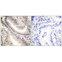Immunohistochemistry analysis of paraffin-embedded human lung carcinoma tissue using TIMP4 antibody.