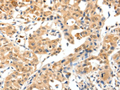 The image on the left is immunohistochemistry of paraffin-embedded Human lung cancer tissue using TPM2 Antibody(TPM2 Antibody) at dilution 1/25, on the right is treated with synthetic peptide. (Original magnification: ×200)Rabbit anti-Human TPM2 Polyclonal Antibody