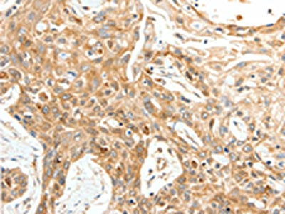 The image on the left is immunohistochemistry of paraffin-embedded Human esophagus cancer tissue using the antibody Antibody) at dilution 1/25, on the right is treated with synthetic peptide. (Original magnification: ×200)Rabbit anti-Human TPM2 Polyclonal Antibody