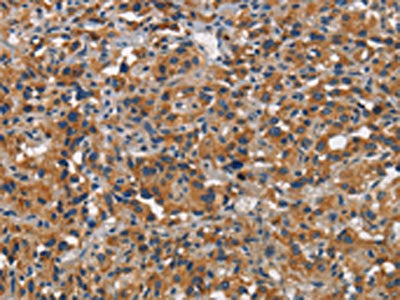 The image on the left is immunohistochemistry of paraffin-embedded Human thyroid cancer tissue using CEACAM1 Antibody(CEACAM1 Antibody) at dilution 1/30, on the right is treated with synthetic peptide. (Original magnification: ×200)Rabbit anti-Human CEACAM1 Polyclonal Antibody
