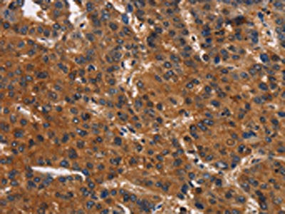 The image on the left is immunohistochemistry of paraffin-embedded Human liver cancer tissue using the antibody Antibody) at dilution 1/30, on the right is treated with synthetic peptide. (Original magnification: ×200)Rabbit anti-Human CEACAM1 Polyclonal Antibody